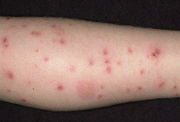 dermet_photo_of_flea_bites_on_leg-590x400-1