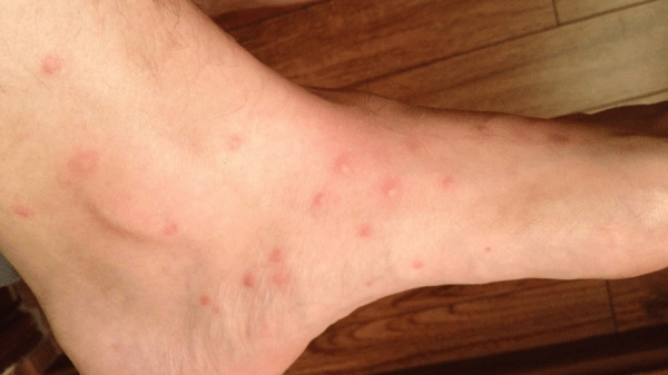 flea-bites-600x337-1